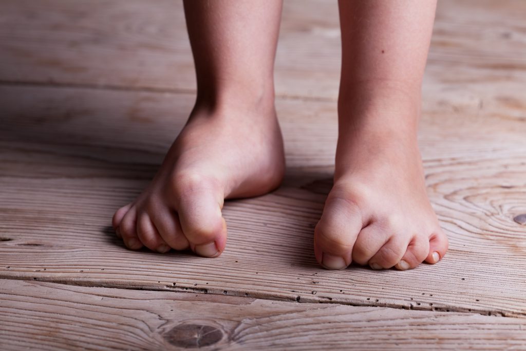 Symptoms Of Foot Gout