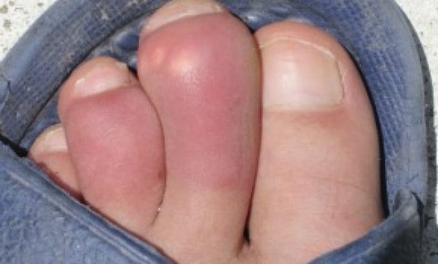 Symptoms Of Gout In Foot For You Knowledge