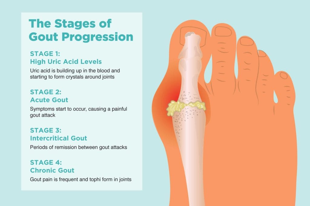 The 4 Stages of Gout and Preventing Disease Progression