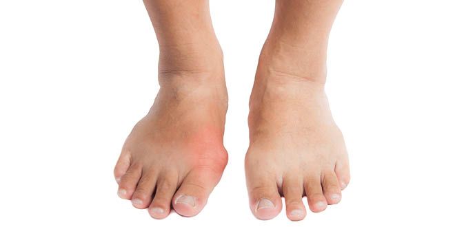 The best and worst foods for gout