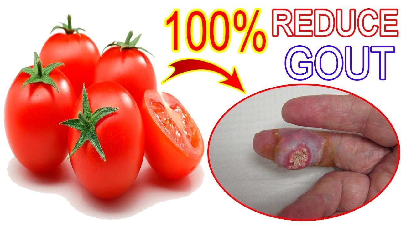 The Best Food For Gout Naturaly  Tomato Is Amazing Fruit ...