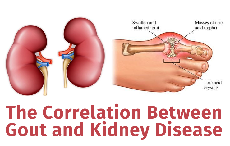 The Correlation Between Gout and Kidney Disease