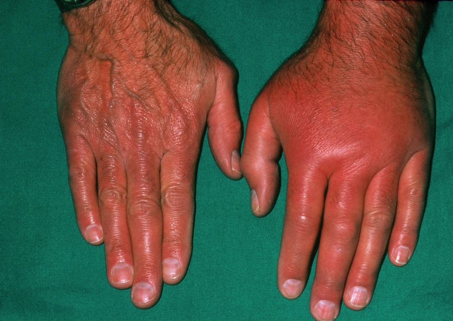 The Hand Of A Patient Affected By Gout Photograph by Dr P ...