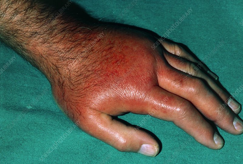 The hand of a patient affected by gout