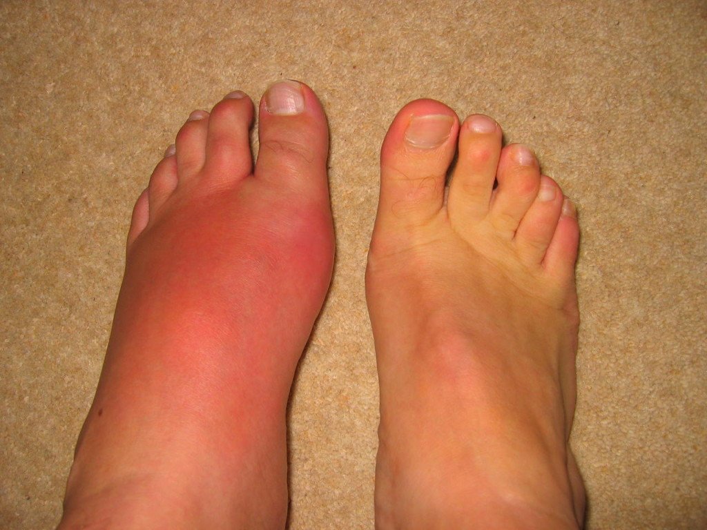 The rise of gout