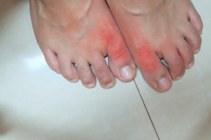 The ULTIMATE Guide to Know Everything about Gout Symptoms