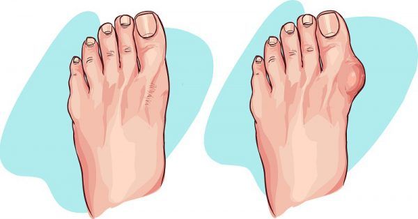 Top 22 Natural Home Treatments for Gout