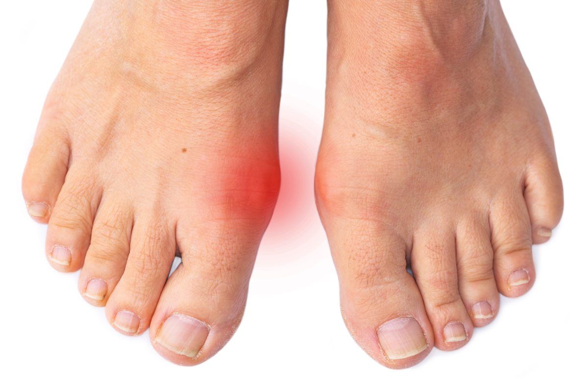Treat Gout and Arthritis in West Vancouver