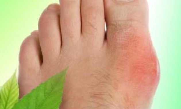 Treatment for Gout in Foot Remedy to Free from Gout