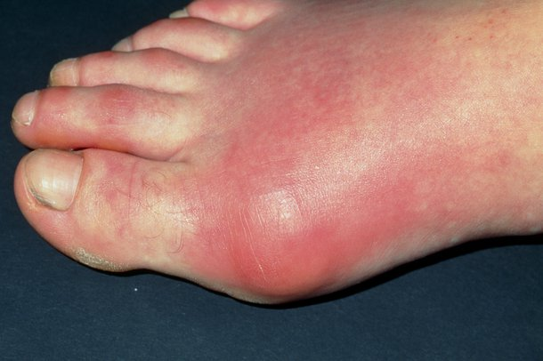 Understanding Gout: Symptoms, Risk Factors, And Prevention