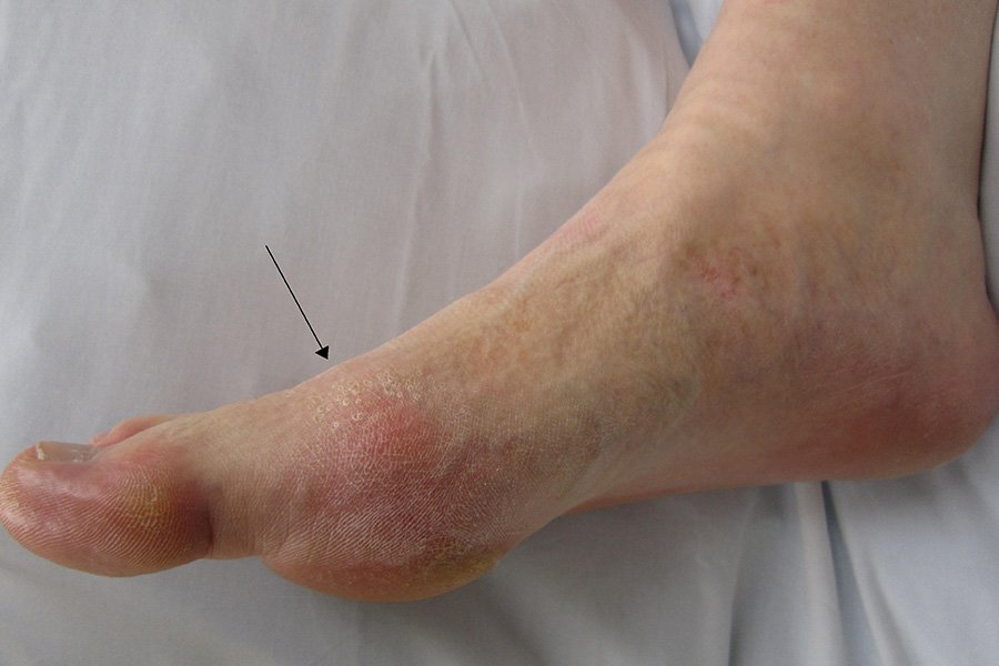 Understanding Gout: What You Need to Know in 10 Photos
