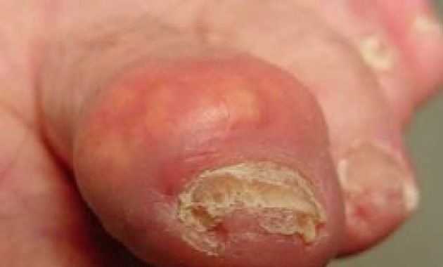 Understanding Signs Of Gout