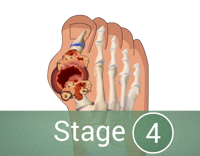 What are the 4 stages of gout?