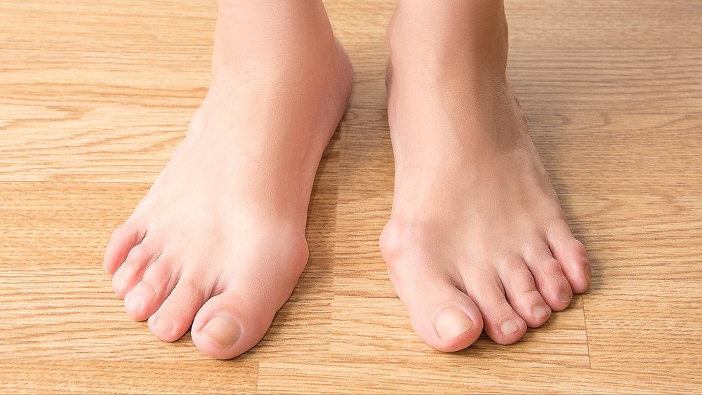 What can I do for a Bunion?