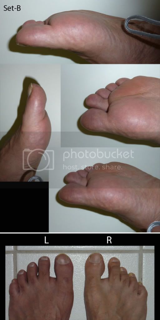 What Can You Do For A Gout Attack