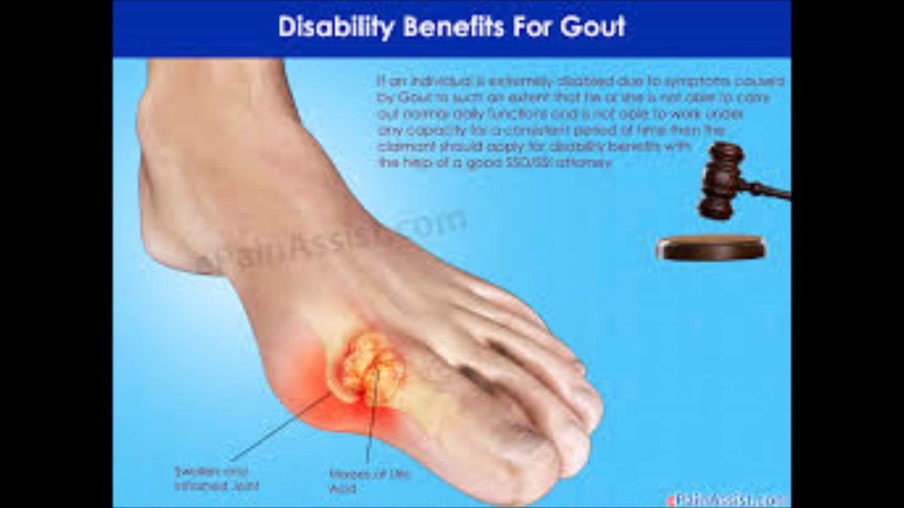 What Can You Take For Gout To Help Naturally