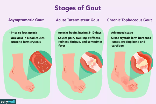 What cause you to have a gout on your feet?