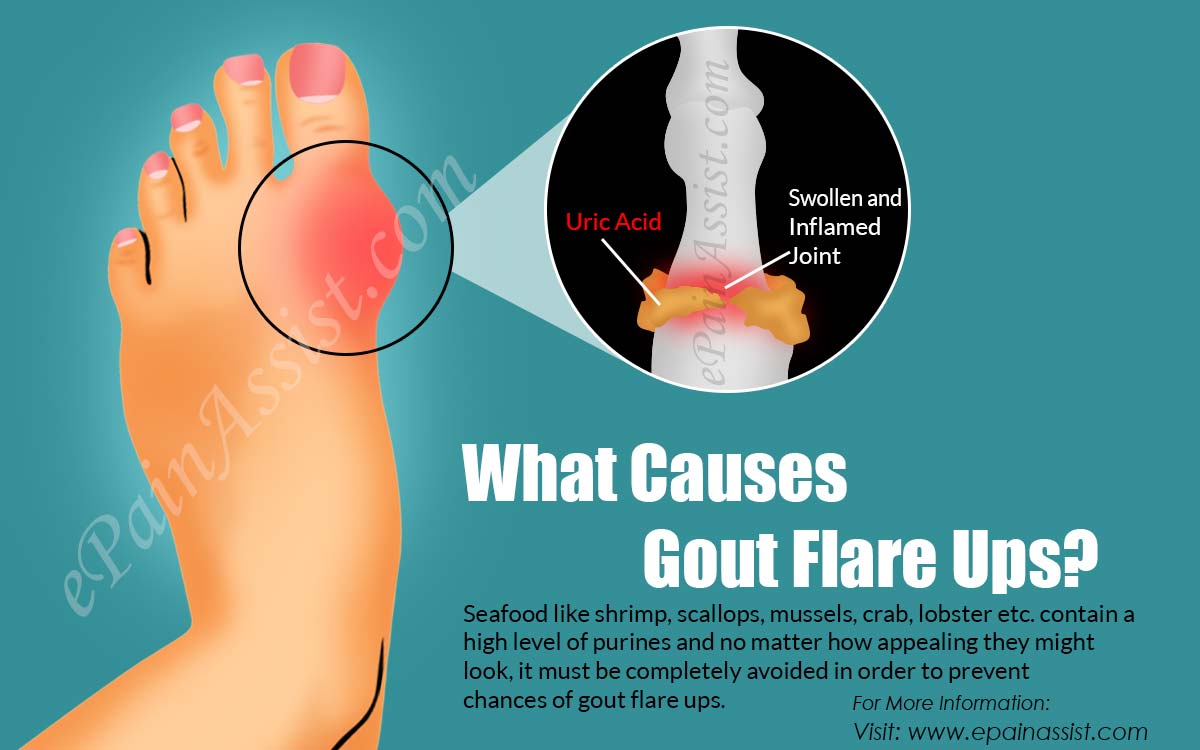 What Causes Gout Flare Ups &  How to Get Rid of it?