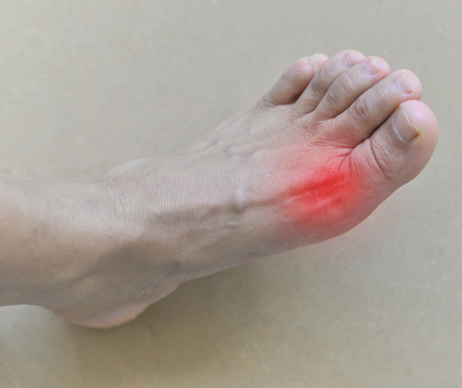 What Causes Gout In The Foot?  My FootDr