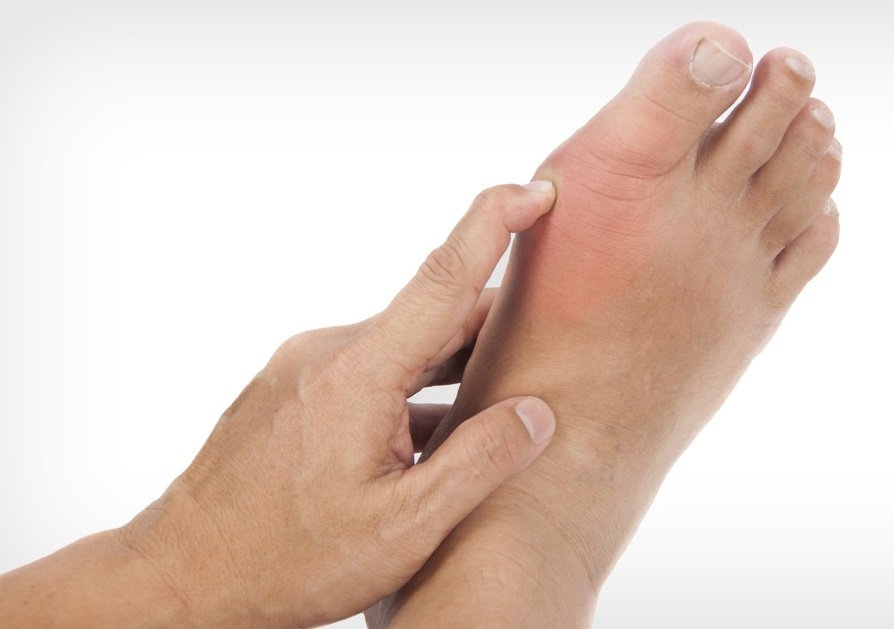 What Does Gout Look Like: Some Details Of The Disease