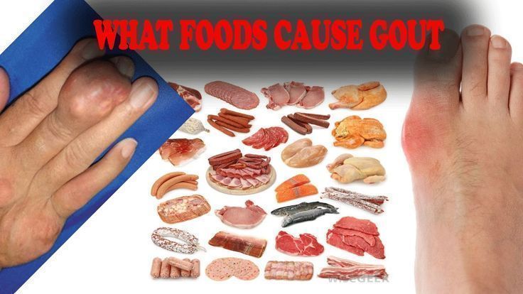 What Foods Cause Gout (Gout in Hands Gout in Big Toe Gout ...
