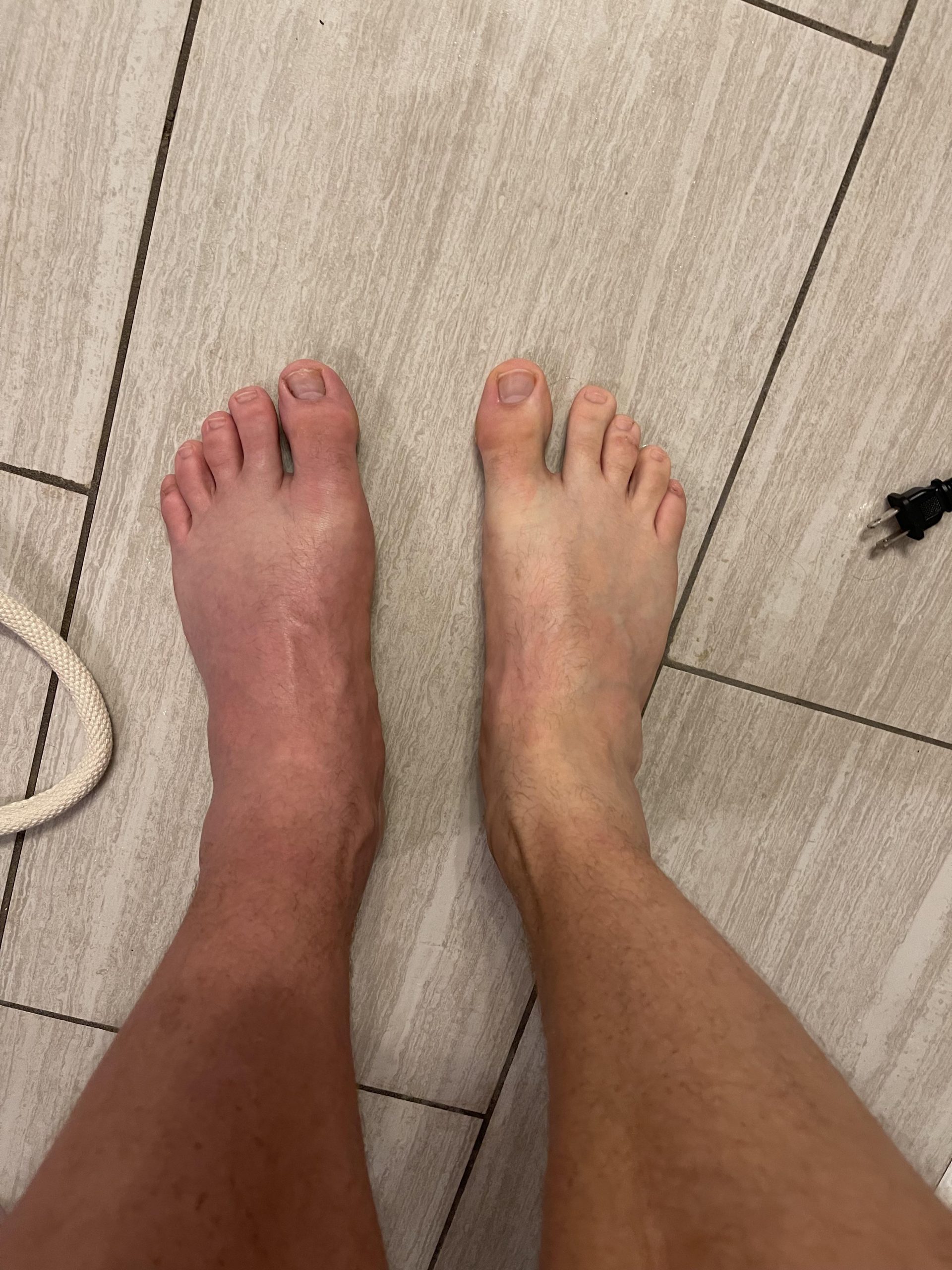 What gout looks like. So very painful : mildlyinteresting