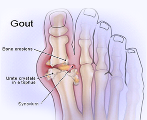 What Happens to Your Body When You Have Gout?