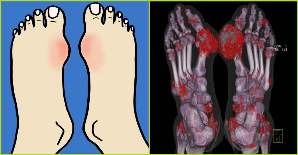 What Is Gout? Causes, Symptoms, And Treatment ...