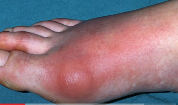WHAT IS GOUT? ITS SYMPTOMS AND HOW TO TREAT GOUT.