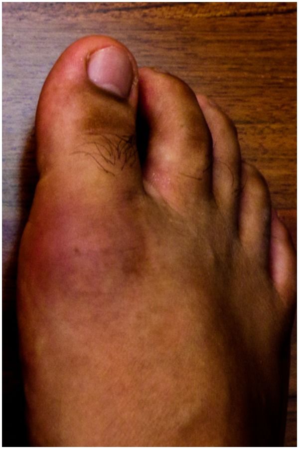 What Is Gout Mean