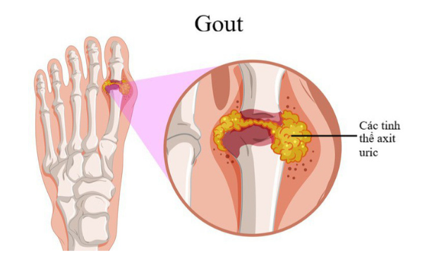 What is The Leading Cause of Gout ?