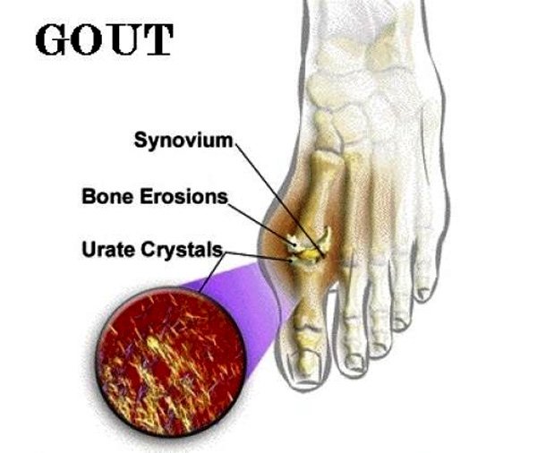 Where does gout come from?