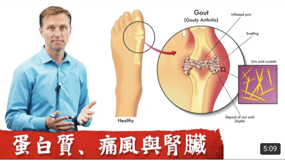 Why dietary protein does not cause gout