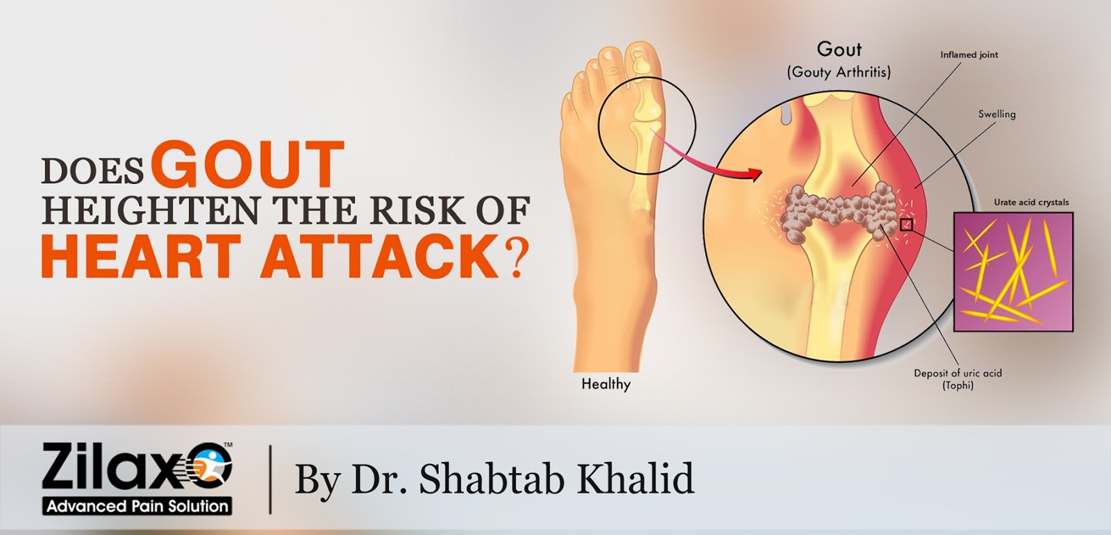 Zilaxo Advanced Pain Solution: Does Gout Heighten The Risk Of Heart Attack?